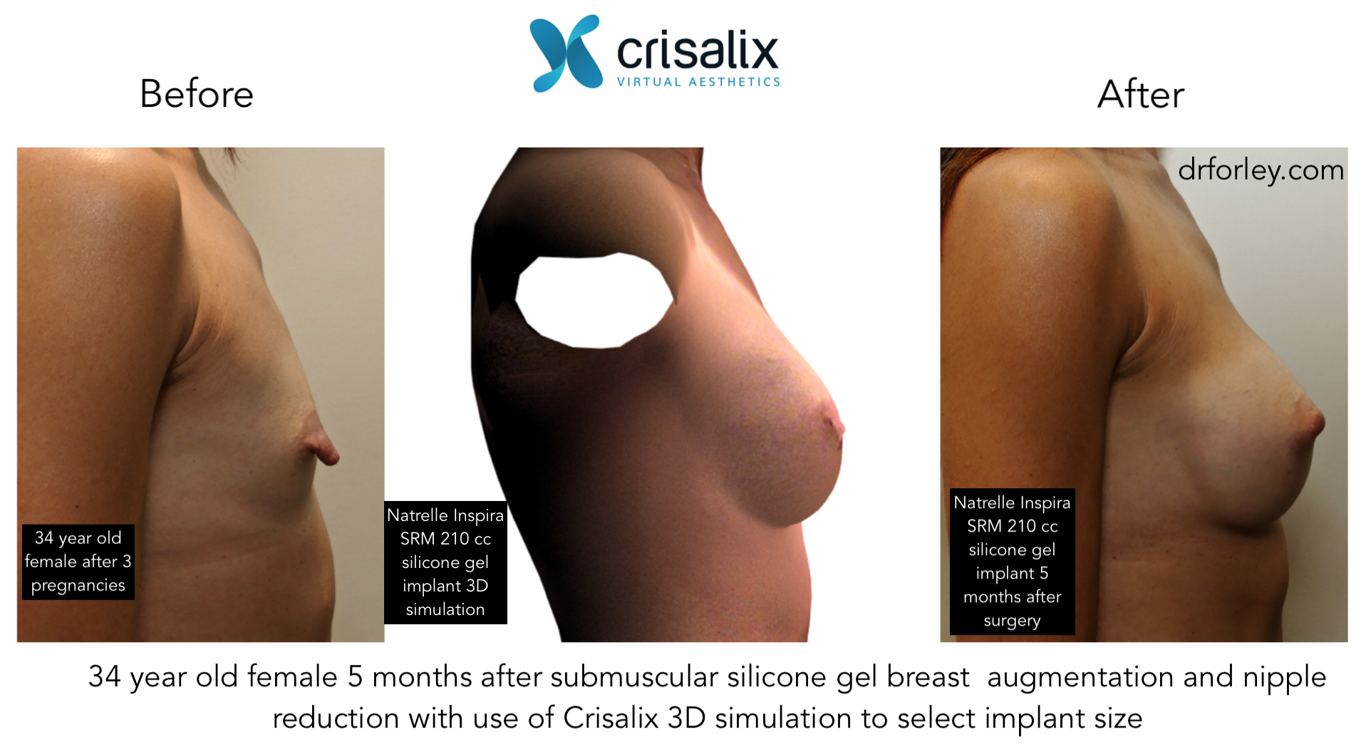 34 year old female 5 months after submuscular silicone gel breast augmentation and nipple reduction with use of Crisalix simulation to select implant size