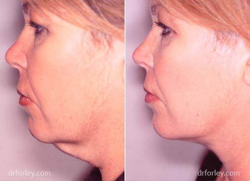 Woman's Face, before and after necklift treatment, neck, left side view, female patient 1