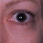 CS-post - Version 2 Blending of lower eyelid/cheek junction after treatment