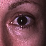 CS-pre - Version 2 Tear trough at lower eyelid/cheek junction