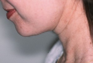 Neck post 1 After Neck Lift