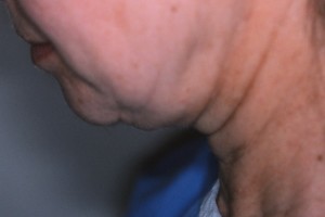 Neck pre 1 Before Neck Lift