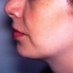 SAL neck post After Liposuction of Neck