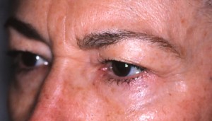 IMG - Version 2 Before Endoscopic Browlift