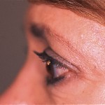 JL 1 month post-Ultherapy 1 month after Ultherapy