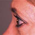 JL pre-Ultherapy - Version 2 Before Ultherapy