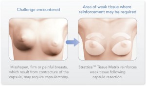 feature-capsular-contracture Capsular Contracture