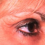 MJD post 1 After Lateral brow sagging