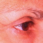 MJD pre 1 Before Lateral brow sagging