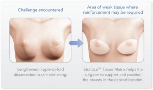feature-bottoming-out Bottoming Out