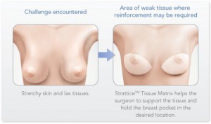 feature-mastopexy Augmentation Mastopexy