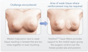 feature-symmastia Symmastia