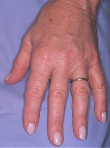 IMG post After - HAND REJUVENATION