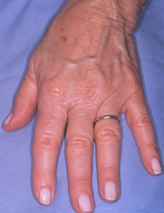 IMG pre Before - HAND REJUVENATION