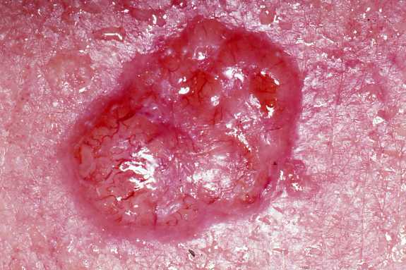 Basal_cell_carcinoma Squamous Cell Carcinoma