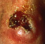 Squamous_Cell_Carcinoma Basal Cell Carcinoma