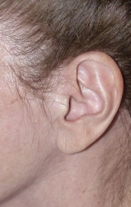 A well healed facelift scar in a female patient at 1 year