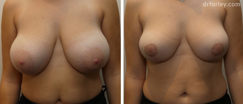 Female breast, before and after Breast Lift treatment, front view, patient 2