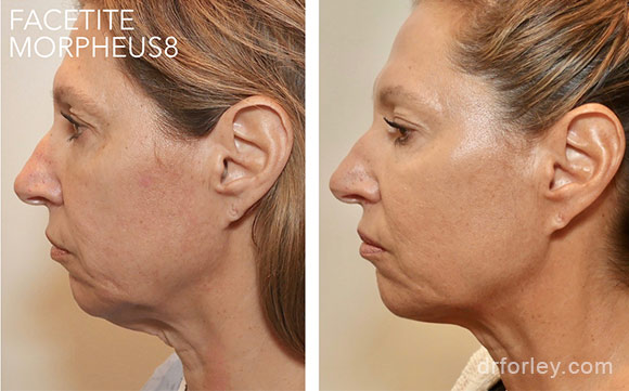 Woman's face, before & after FACETITE treatment  photo, side view, patient 1