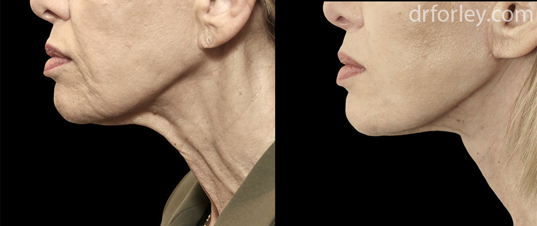 Before & After Tightening Set11 thumb1