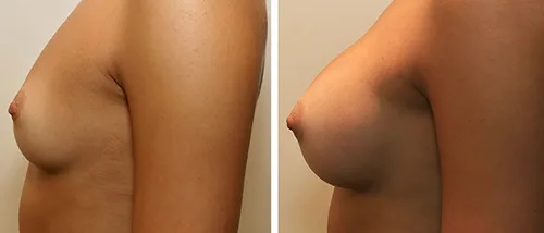 LEARN MORE ABOUT DR. FORLEY'S WORK: Breast Augmentation
