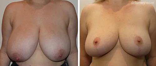 LEARN MORE ABOUT DR. FORLEY'S WORK: Breast Reduction