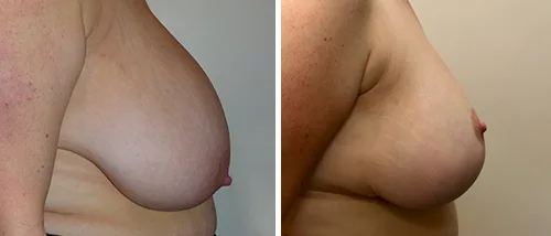 LEARN MORE ABOUT DR. FORLEY'S WORK: Breast Lift