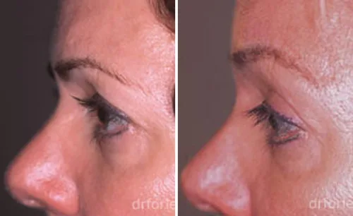 LEARN MORE ABOUT DR. FORLEY'S WORK: Brow Lift