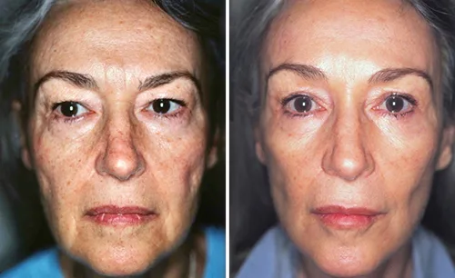 LEARN MORE ABOUT DR. FORLEY'S WORK: Facelift