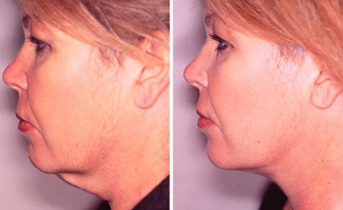 LEARN MORE ABOUT DR. FORLEY'S WORK: Neck Lift