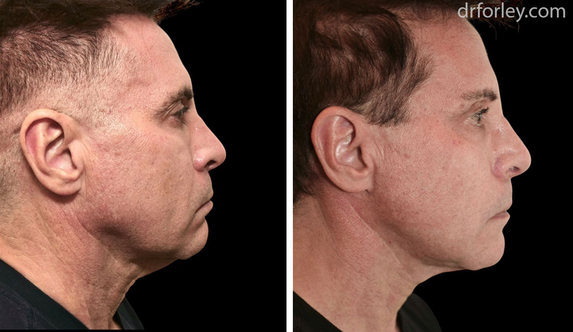 Before & After Tightening Set12 thumb3